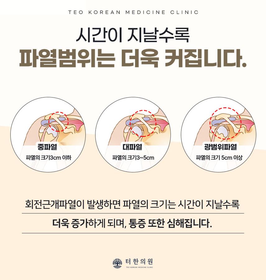 회전근개 파열 범위를 단계별로 설명한 그림
