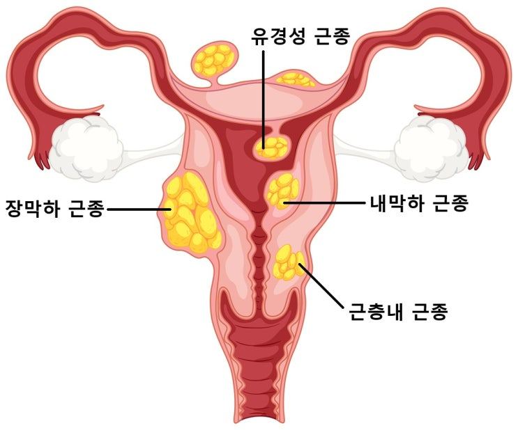 자궁근종 위치를 표시한 해부 그림