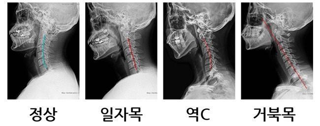 정상 목과 일자목·역C·거북목 엑스레이 비교