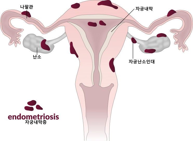 자궁내막증 위치를 표시한 그림