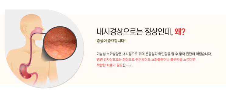 기능성 소화불량을 설명한 위장 그림