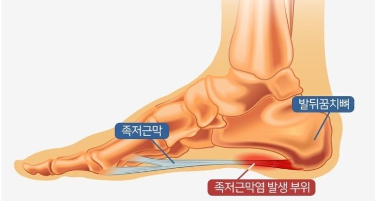 족저근막과 발뒤꿈치뼈, 염증 발생 부위를 표시한 발 해부 그림