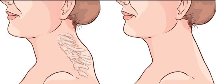 앞으로 나온 목과 정상적인 목의 차이를 보여 주는 옆모습 삽화