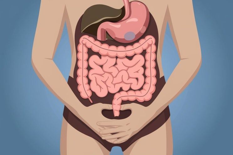 복부를 감싸 쥔 사람의 몸에 위와 장기를 겹쳐 표현한 삽화
