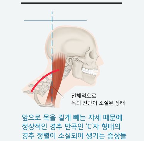 목을 앞으로 길게 뺀 자세에서 경추 정렬이 흐트러지는 모습을 보여 주는 해부 그림