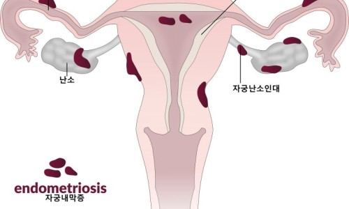 자궁과 난소에 자궁내막증 병변 위치를 표시한 의학 그림