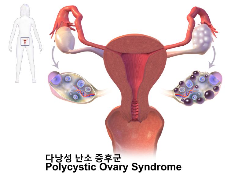 다낭성 난소 증후군의 난소 변화를 보여 주는 여성 생식기관 그림